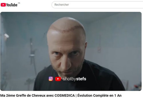 Les français choisissent de plus en plus de réaliser leurs implants capillaires en Turquie