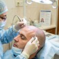 Intervention d'implants capillaires en Turquie réalisée sur un patient dans une clinique spécialisée